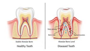 Understanding the progression of periodontal disease is the first lesson in our pet dental care guide.